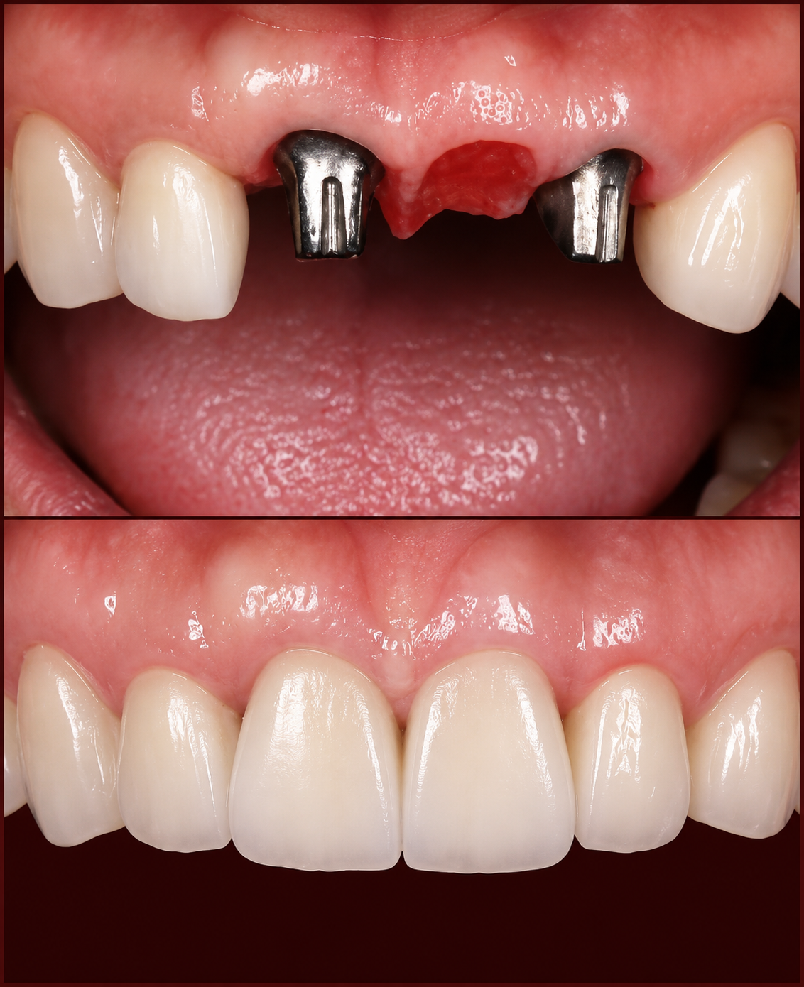 Implant Site Development