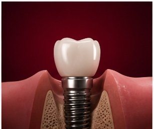 Single Tooth Implants
