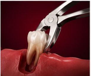 Surgical Tooth Extraction