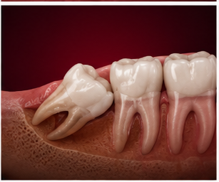Surgical Impactions